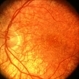 Rubella retinopathy Rubella retinopathy